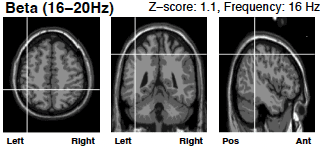 beta wave brain scan beta wave brain scan after neurofeedback